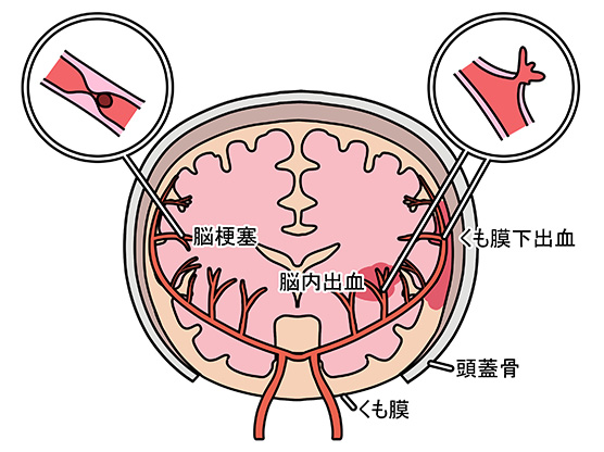 脳血管が塞がる疾病